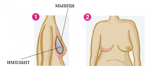Реконструкция груди имплантами