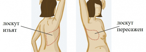 Один из вариантов реконструкции груди собственными тканями пациентки