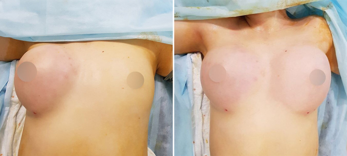 Липофилинг груди Пенаев