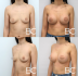 Фото пациентки до и после увеличения груди у доктора Валерия Стайсупова