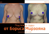 Кому доверить пластику груди в Москве? Европейский опыт, безупречная репутация. Пластический хирург Борис Мирзоян.