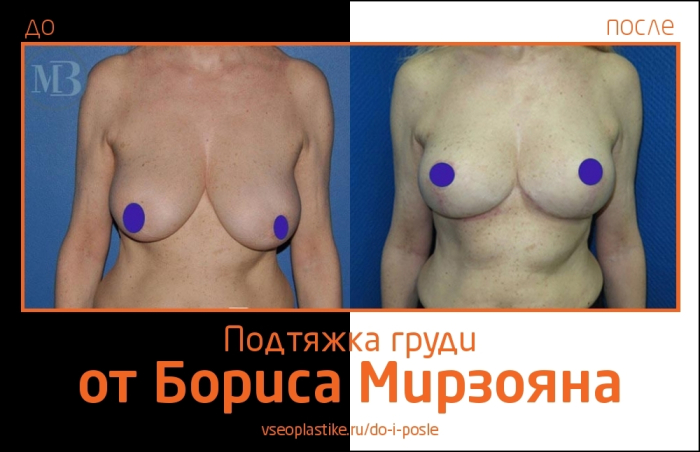 Увеличение груди Борис Мирзоян