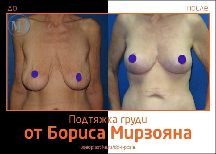 Увеличение груди Борис Мирзоян