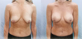 Импланты среднего профиля