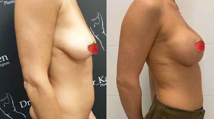 Фото до и после подтяжки и увеличения груди у пластического хирурга Карена Пайтяна