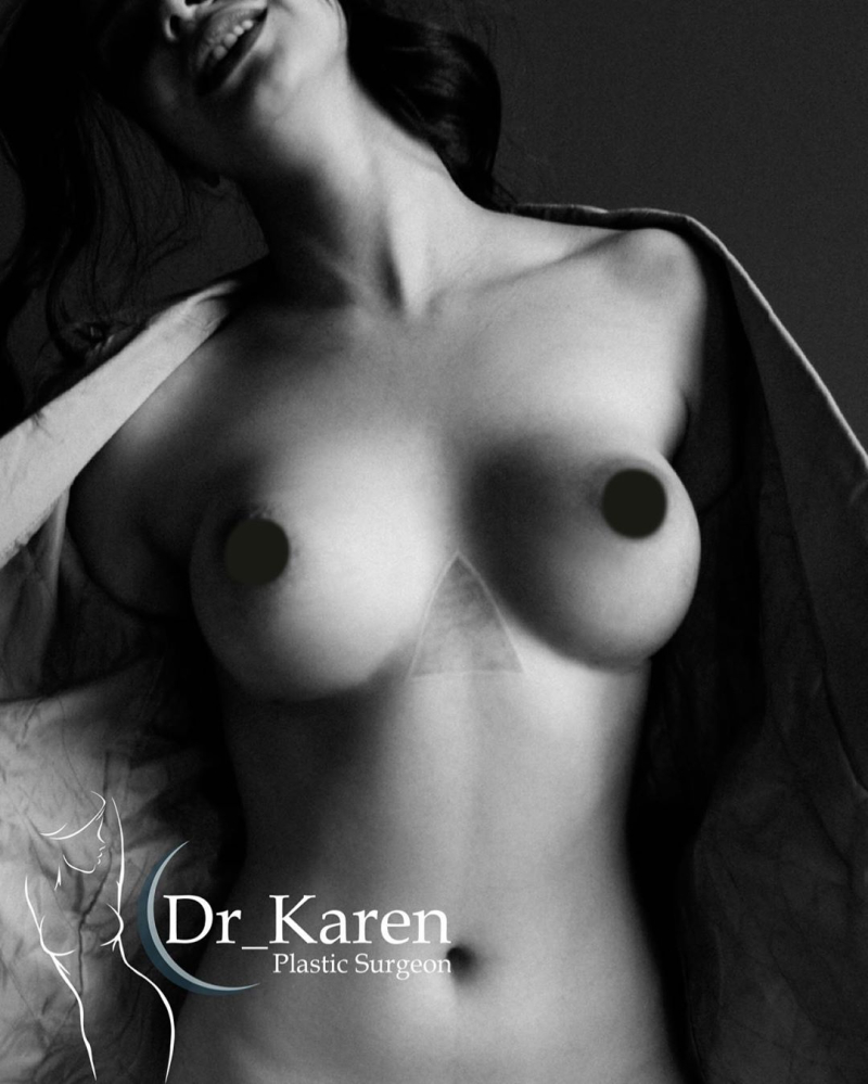 Фото пациентки доктора Карена Пайтяна после увеличивающей маммопластики