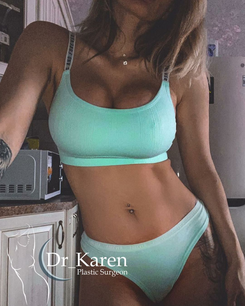 Фото пациентки пластического хирурга Карена Пайтяна после маммопластики