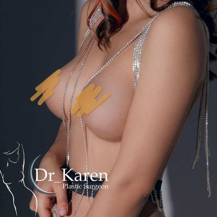 Пациентка после имплантации молочных желез у доктора Карена Пайтяна