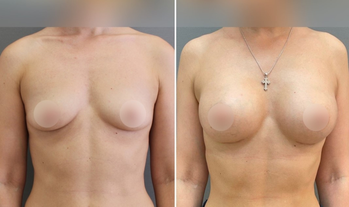 После увеличения груди