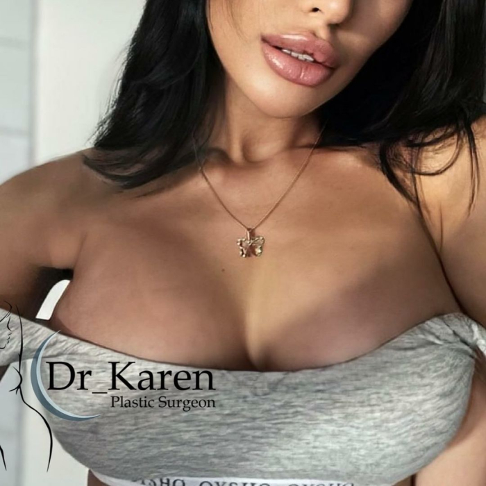 Пациентка после имплантации груди у пластического хирурга Карена Пайтяна
