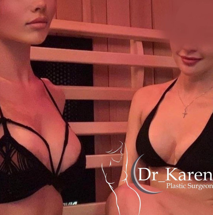 Две пациентки после увеличения груди у доктора Карена Пайтяна