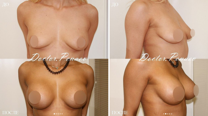Пациентка пластического хирурга Арслана Пенаева. Фото до и после увеличения груди имплантатами.