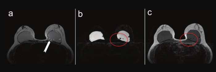 Маммограмма разрыва грудного импланта