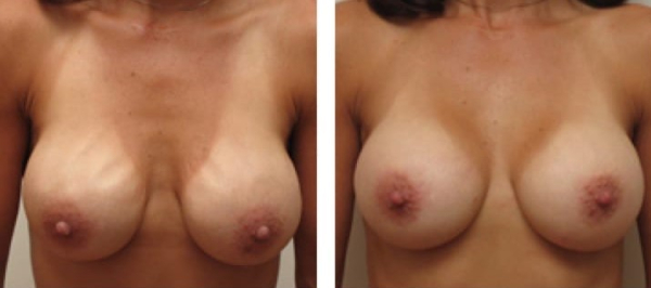 Риплинг груди и фото после исправления осложнения