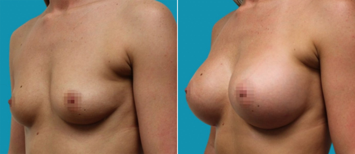 увеличение груди цена в Москве