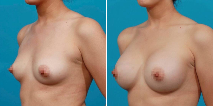 увеличение груди цена в Москве