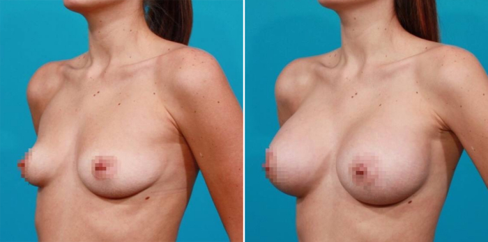 увеличение груди цена в Москве