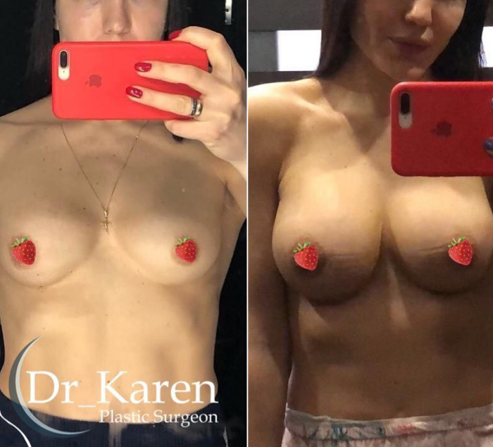 Замена имплантов Москва Карен Пайтян