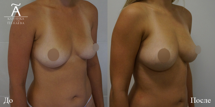 Пациентка пластического хирурга Арслана Пенаева до и после операции по липофилингу груди.