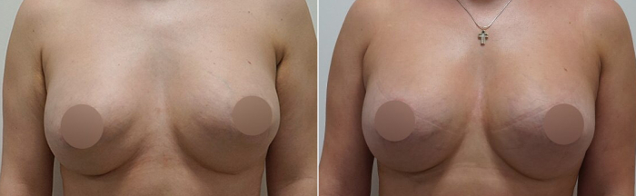 липолфилинг после удаления имплантов