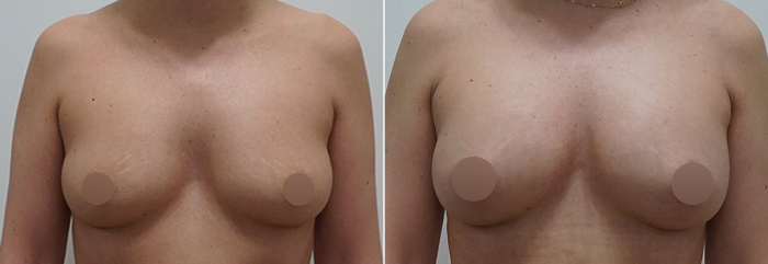 увеличение груди жиром