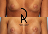 Амрам Пайтян. Увеличение груди со скидкой
