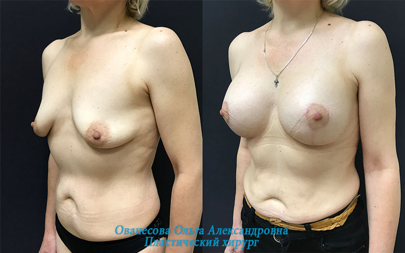 Пациентка Елена пластического хирурга Ольги Ованесовой до и после увеличения и подтяжки груди