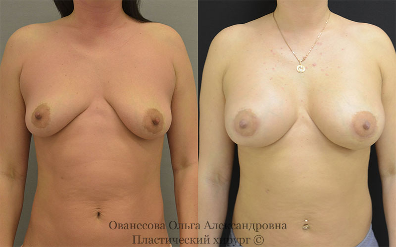 Пациентка Галина пластического хирурга Ольги Ованесовой до и после увеличения и подтяжки груди