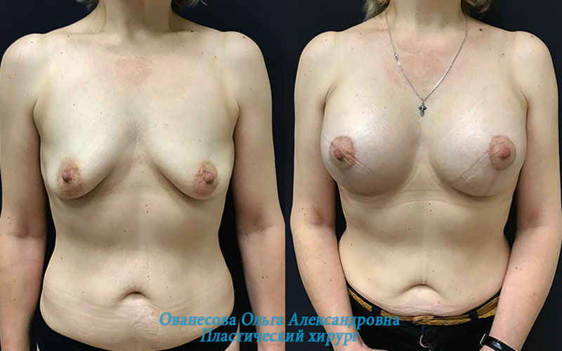 Пациентка Елена пластического хирурга Ольги Ованесовой до и после увеличения и подтяжки груди.