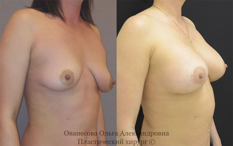 Пациентка Галина пластического хирурга Ольги Ованесовой до и после увеличения и подтяжки груди в Москве