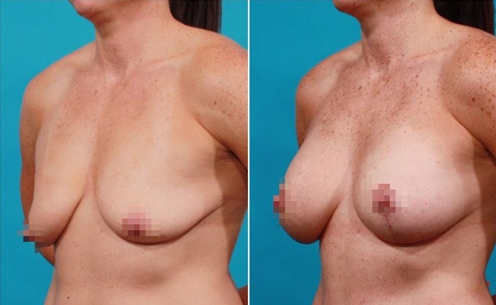 Пациентка доктора Миракяна до и после одномоментной операции по подтяжке и увеличению молочных желез