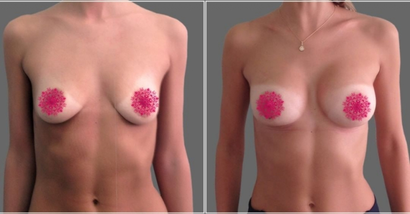 Пациентка доктора Д.А. Рябцева до и после увеличения груди