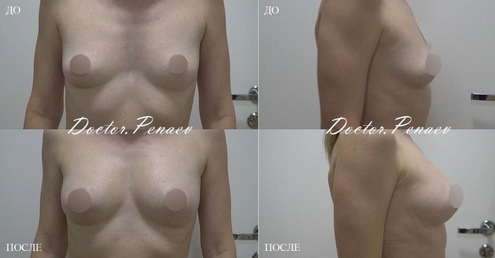 Пациентка Анна (38 лет) пластического хирурга Арслана Пенаева до и после липотрансфера груди