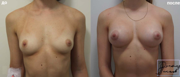 Пациентка  пластического хирурга Арслана Пенаева. Фото до и после увеличения груди имплантами MX 290 мл