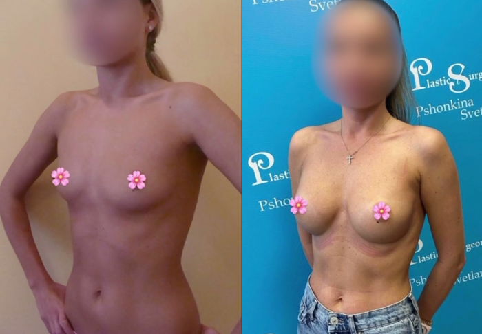 Пациентка пластического хирурга Светланы Пшонкиной. Фото до и после увеличения груди имплантами