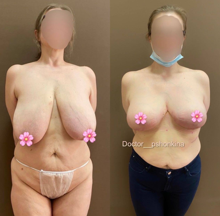 пациентка пластического хирурга Светланы Пшонкиной. Фото до и после уменьшающей маммопластики