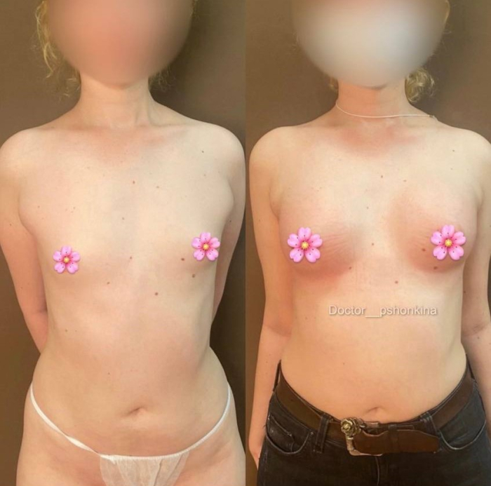 Пациентка пластического хирурга Светланы Пшонкиной. Фото до и после увеличения груди имплантами