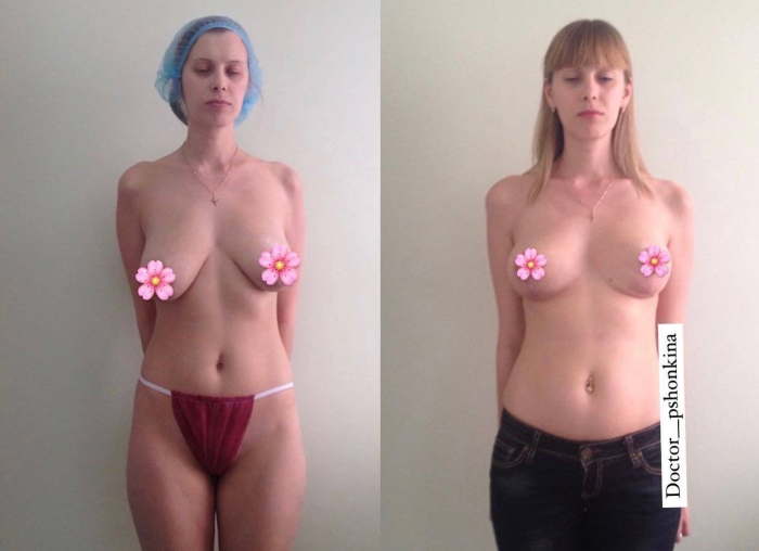 Пациентка пластического хирурга Светланы Пшонкиной. Фото до и после подтяжки груди