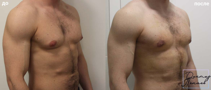 Пациент доктора Арслана Пенаева до и после операции по уменьшению мужской груди