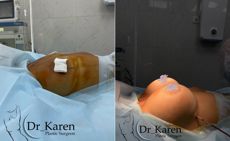 Пациентка пластического хирурга Карена Пайтяна после маммопластики