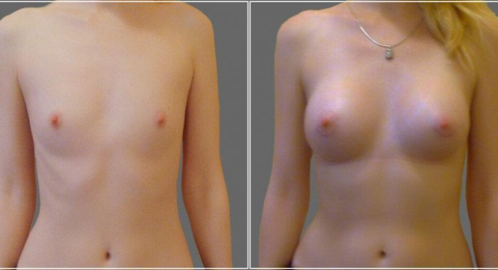 Пациентка пластического хирурга Дмитрия Рябцева. Фото до и после увеличения груди имплантами