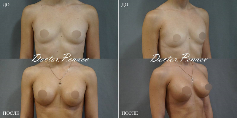 Пациентка доктора Пенаева до и после увеличения груди имплантами.