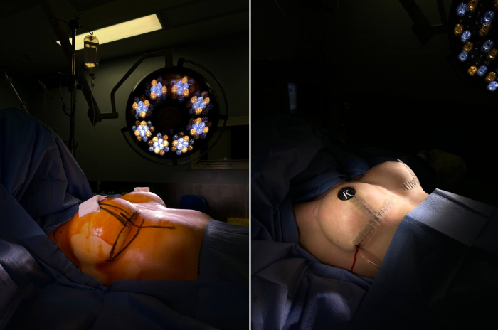 Пациентка доктора Карена Пайтяна до и после реэндопротезирования груди