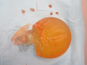 Как определить разрыв грудного импланта?