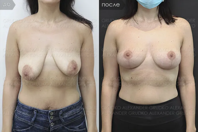 Пациентка доктора А.Грудько. Фото до и после пластики груди