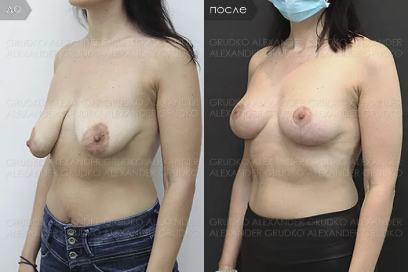 Пациентка доктора А.Грудько. Фото до и после пластики груди