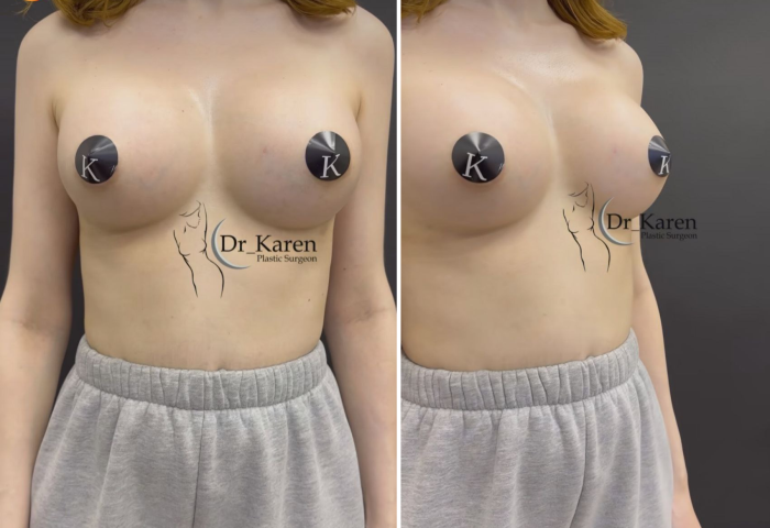 Пациентка пластического хирурга Карена Пайтяна после увеличения груди имплантами