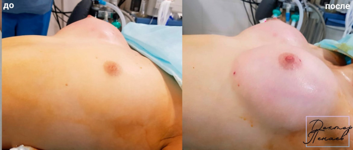 Пациентка пластического хирурга Арслана Пенаева до и после липофилинга груди. Фото на операционном столе