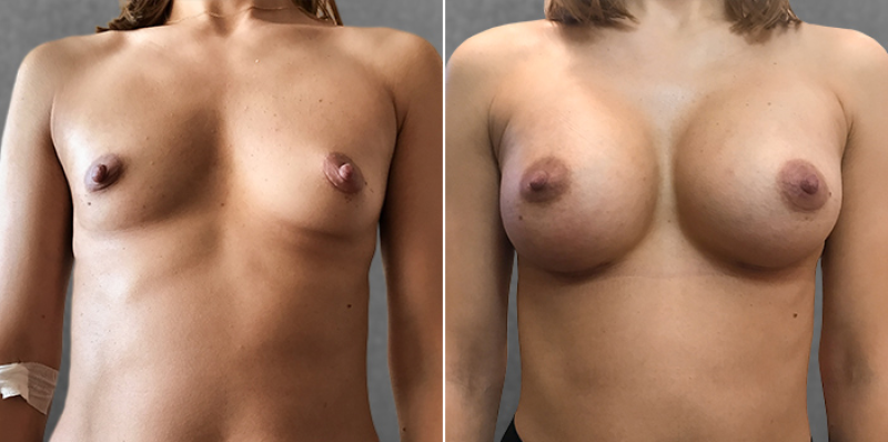 Пациентка пластического хирурга Дмитрия Крысина до и после увеличения груди имплантами