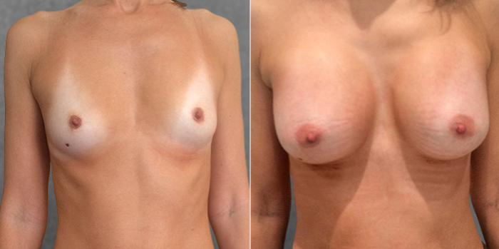 Пациентка доктора Крысина до и после увеличения груди